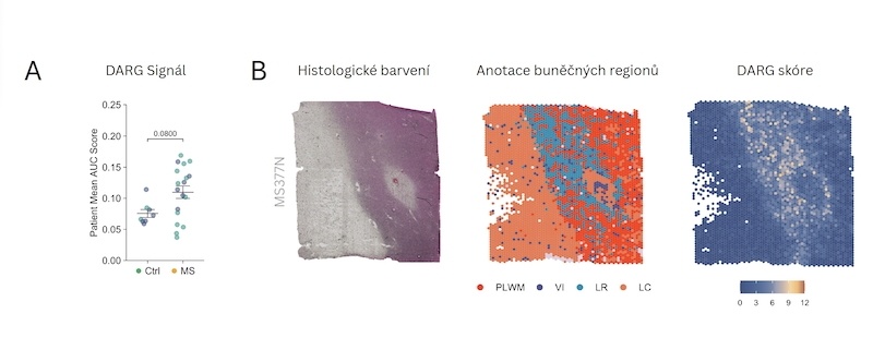 DARG buňky v mozku pacientů s roztroušenou sklerózou